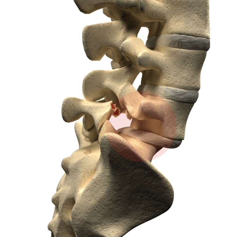 Spondylolisthesis